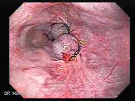 Hemorrhage After Ligation - Closer Look at the Ligated Varix