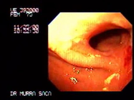 Cancer of the Antrum