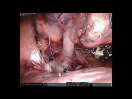 Middle Lobe Robotic Resection
