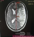 Decompressive Craniotomy