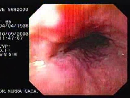 Banding of Esophageal Varices - Assessment of Esophageal Mucosa