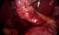 Difficult Lap Cholecystectomy-Mucocele/Pyocele GB
