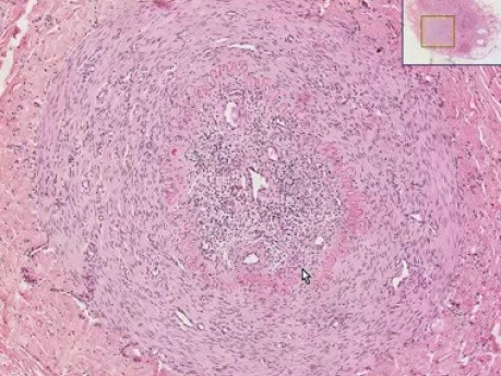 Buergers disease