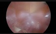 Laparoscopic Ultralow Rectal Resection with a Modified Transanal Anastomisis - an Alternative of TaTME