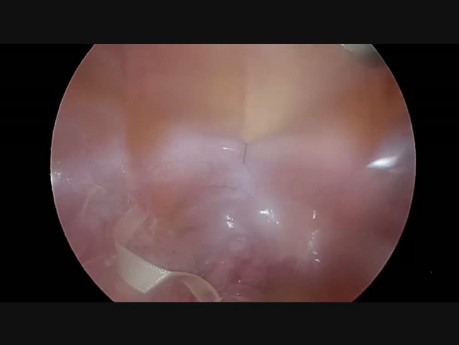 Laparoscopic Ultralow Rectal Resection with a Modified Transanal Anastomisis - an Alternative of TaTME