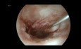 Endoscopic Tympanoplasty and Ossiculoplasty for Chronic Suppurative Otitis Media