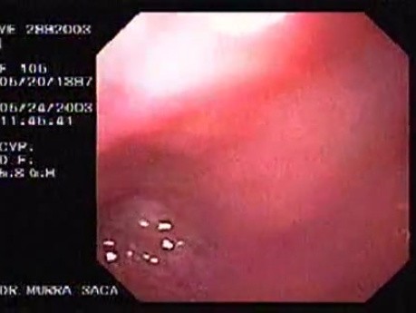 Barret´s Esophagus long segment (4 of 4)