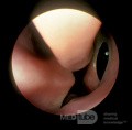 Accessory Maxillary Sinus Ostium [large]