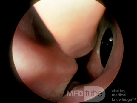 Accessory Maxillary Sinus Ostium [large]
