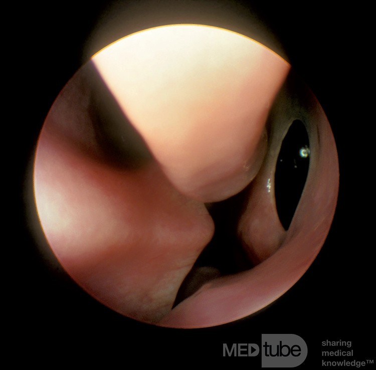 Accessory Maxillary Sinus Ostium [large]