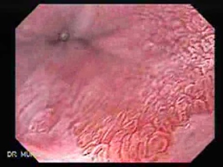 Gastric Heterotopia (inlet pach) (2 of 4)