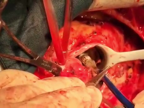 Biological Aorta Valve in Valve Operations with TAVI Valve