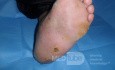 Left Charcot's foot with planter ulcer
