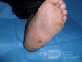 Left Charcot's foot with planter ulcer