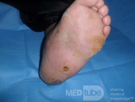 Left Charcot's foot with planter ulcer