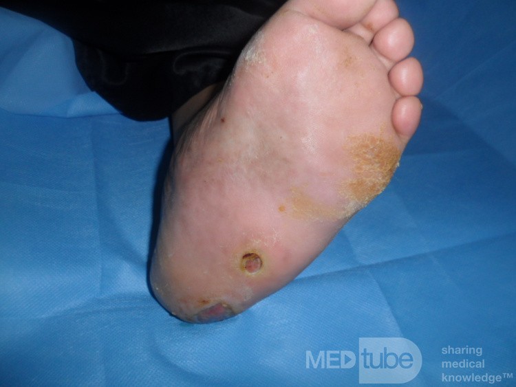 Left Charcot's foot with planter ulcer