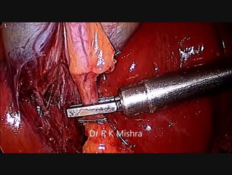 Laparoscopic Cholecystectomy