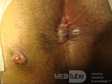 Fistula in Ano (2 of 7)