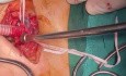 Subclavian to Carotid Bypass in Patient with Carotid Extensive Dissection 