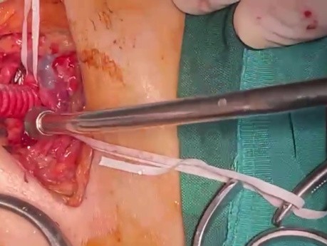 Subclavian to Carotid Bypass in Patient with Carotid Extensive Dissection 