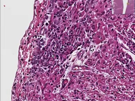 Coxsackie B2 myocarditis