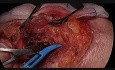Superficial Parotidectomy