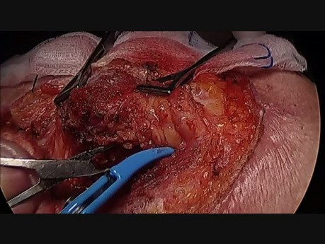 Superficial Parotidectomy