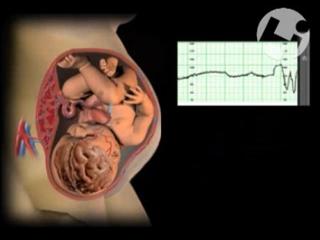 Fetal Heart Rate