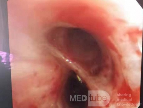Bronchoscopy