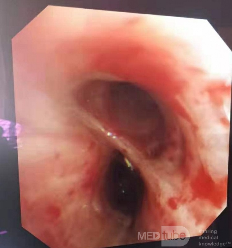 Bronchoscopy