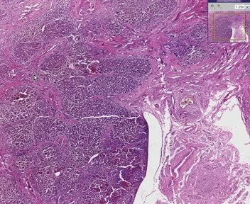 Liver - Primary Biliary Cirrhosis