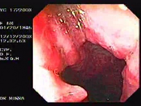 Unspecific Colitis due to Shigellosis (6 of 7)
