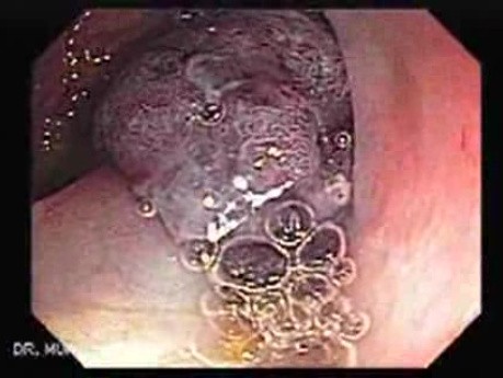 Huge Mass Of The Descending Colon (9 of 25)