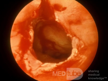 Choanal Atresia Opened