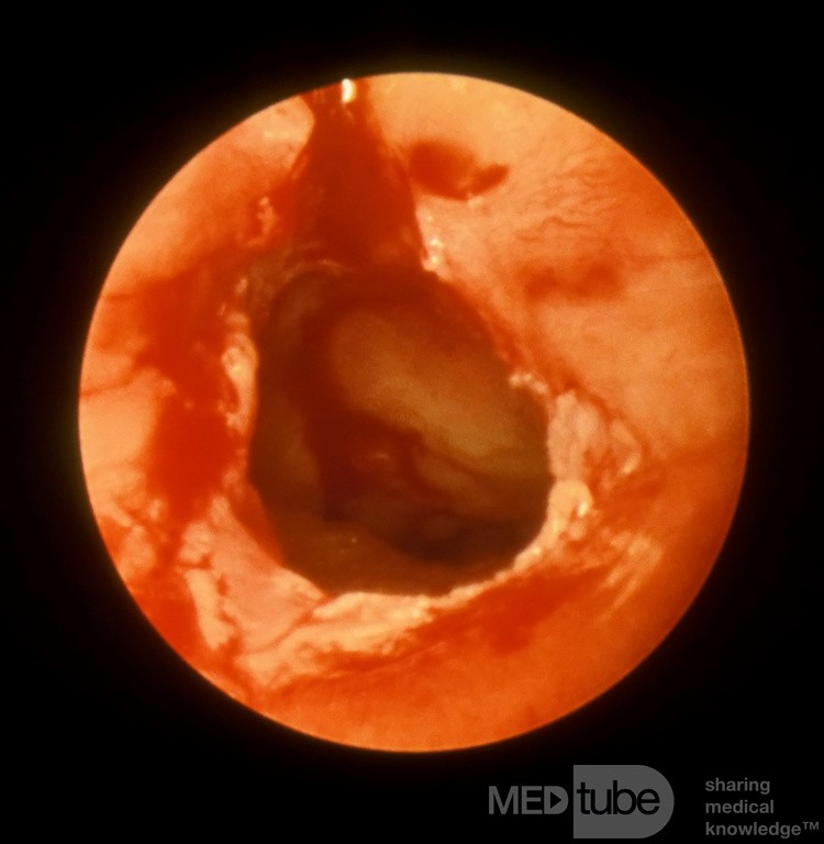 Choanal Atresia Opened