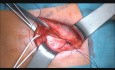 Mesh Free & Tension Free Inguinal Hernia Operation - Desarda Technique