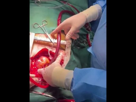 Post Complete Cardiac Death Organ Donation with Zeraatian Technique