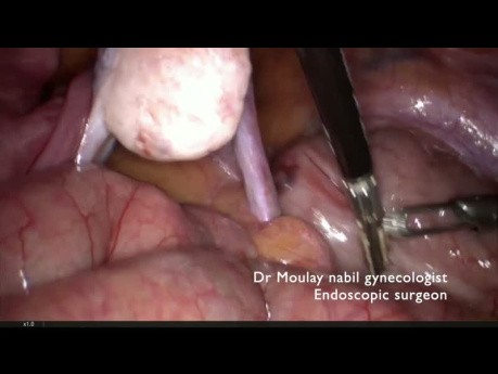 Hysterectomy in Morbid Obese Patient