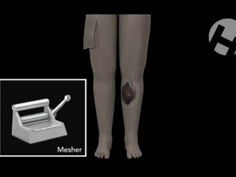 Closure of Lower Leg Wound with Gastrocnemius Muscle Flap and Split-Thickness Skin Grafts