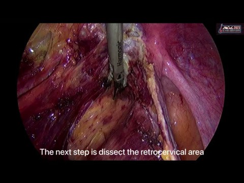 Endometriosis excision 