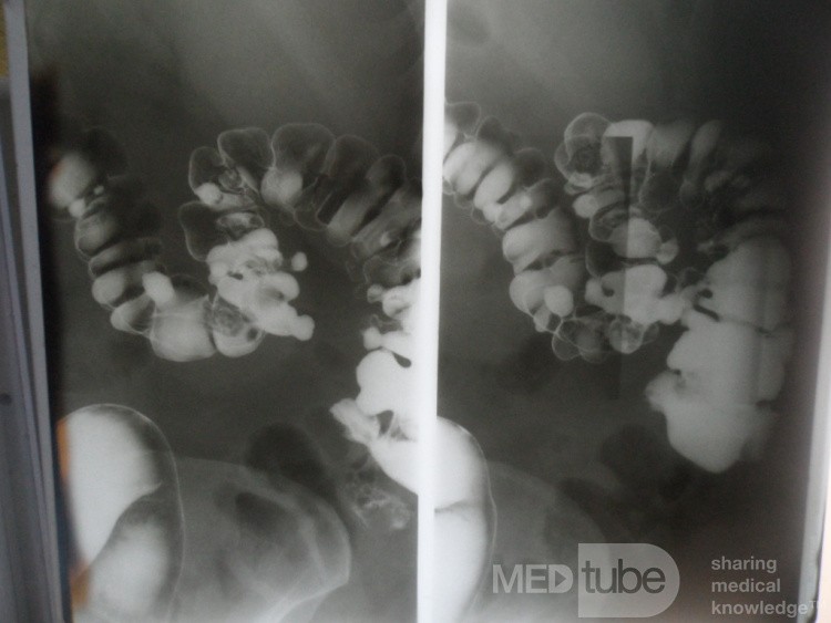 Barium Enema - Diverticulosis