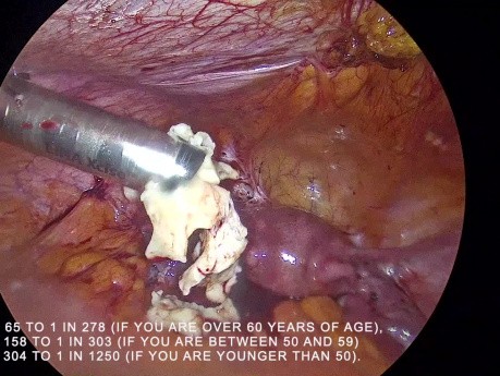 Contained Versus Uncontained Morcellation of Fibroid
