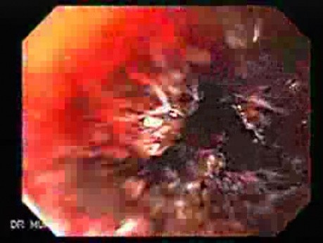 Post Endoscopic Recanalization Of The Esophagus