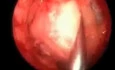 Removal of Neck Lipoma