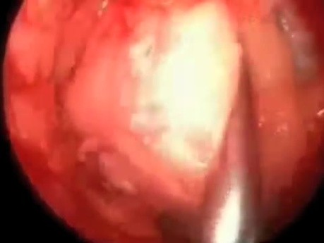 Removal of Neck Lipoma