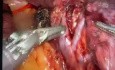 Hillar Lymph Node Dissection 