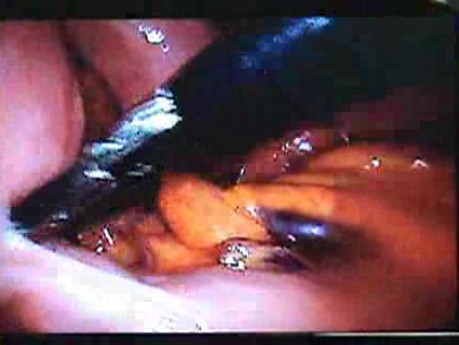 Jejunal Gastrointestinal Stromal tumor (GIST) (21 of 86)