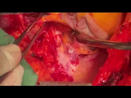 How to Perform MVR in Patient with Small LA Easily via LA Roof