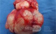 Breast Giant Fibroadenoma