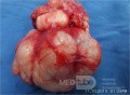 Breast Giant Fibroadenoma